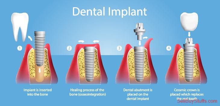 Mumbai Affordable Dental Implants in India